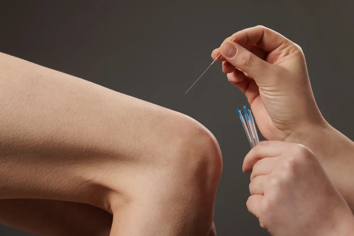Dry needling
